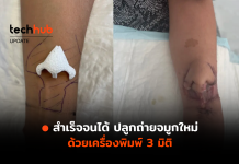 สำเร็จจนได้ ปลูกถ่ายจมูกใหม่ ด้วยเครื่องพิมพ์ 3 มิติ ปลูกถ่ายจมูก