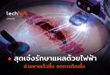 รักษาแผลด้วยไฟฟ้า