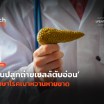ทำสำเร็จ จีนปลูกถ่ายเซลล์ตับอ่อน รักษาโรคเบาหวานหายขาด-60