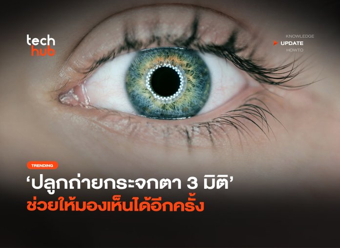 ปลูกถ่ายกระจกตา