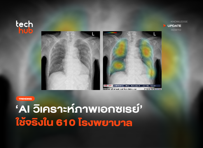 สปสช. ไฟเขียว AI วิเคราะห์ภาพเอกซเรย์ ใช้จริงใน 610 โรงพยาบาล-30 AI สัญชาติไทย